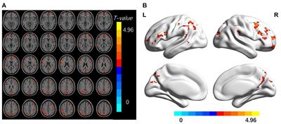 Dynamic local metrics changes in patients with toothache: A resting-state functional magnetic resonance imaging study